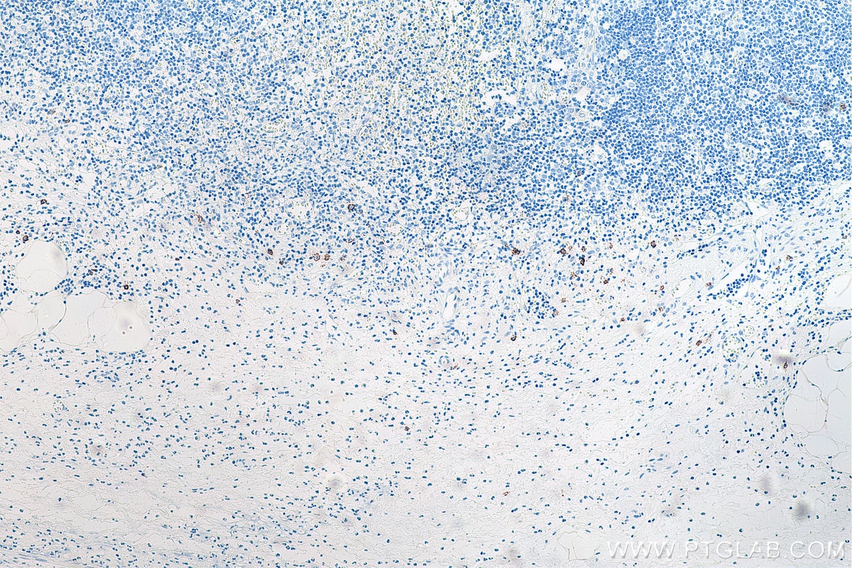 Immunohistochemistry (IHC) staining of human appendicitis tissue using CD138/Syndecan-1 Monoclonal antibody (67155-1-Ig)