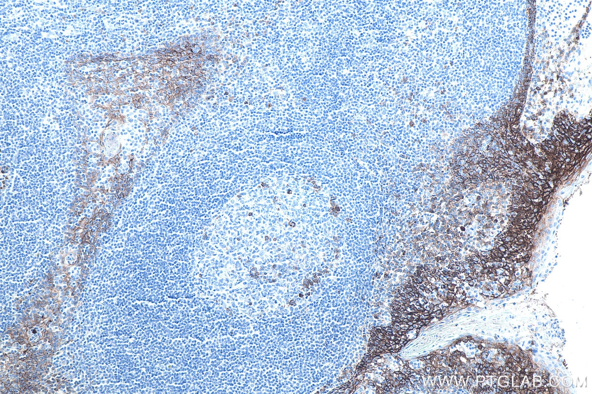 Immunohistochemistry (IHC) staining of human tonsillitis tissue using CD138/Syndecan-1 Monoclonal antibody (67155-1-Ig)