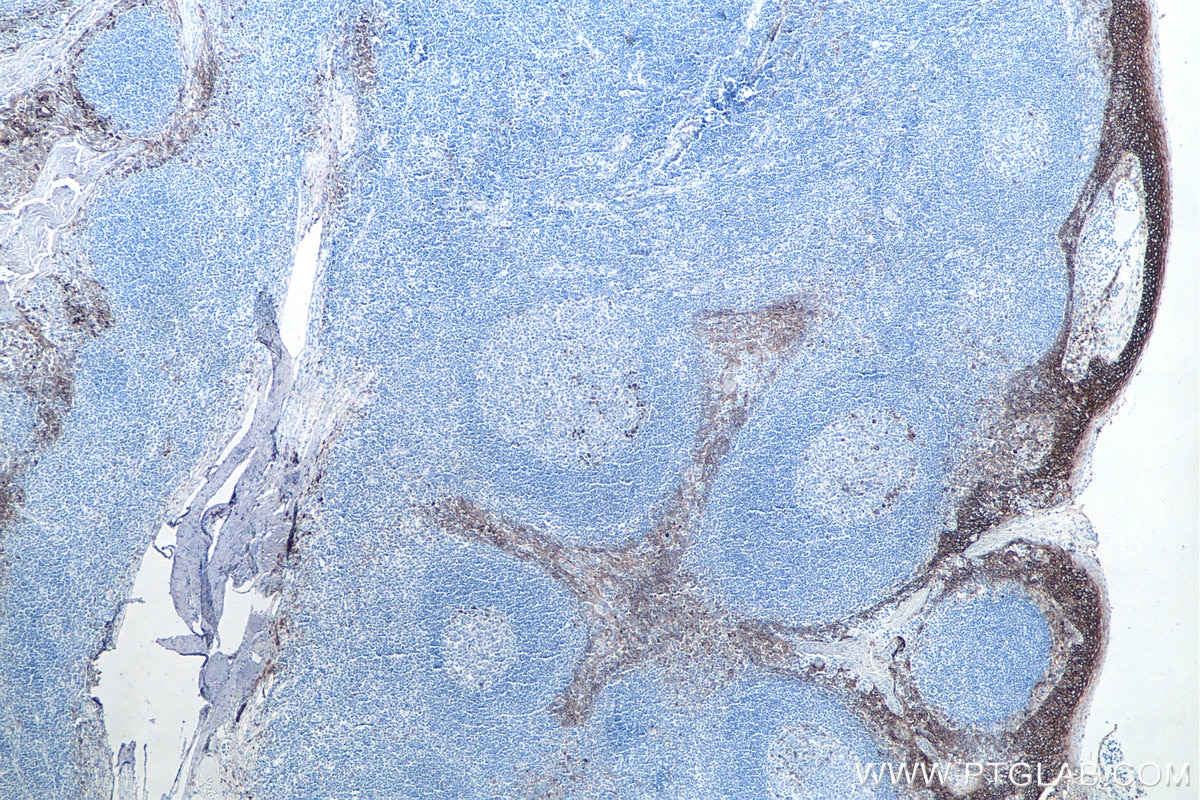 Immunohistochemistry (IHC) staining of human tonsillitis tissue using CD138/Syndecan-1 Monoclonal antibody (67155-1-Ig)