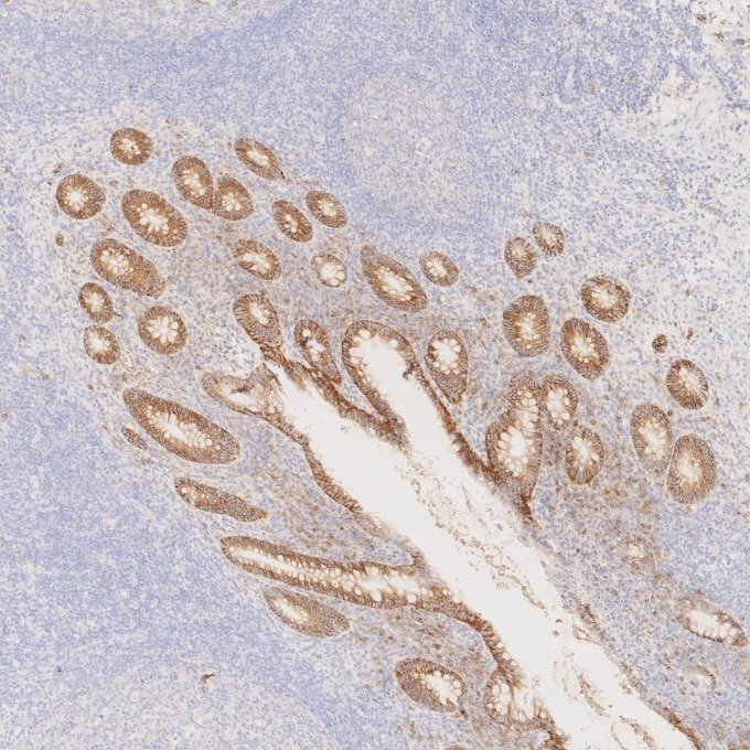 IHC staining of human appendicitis using 67155-1-Ig Immunohistochemistry (IHC) staining of human appendicitis tissue using CD138/Syndecan-1 Monoclonal antibody (67155-1-Ig)