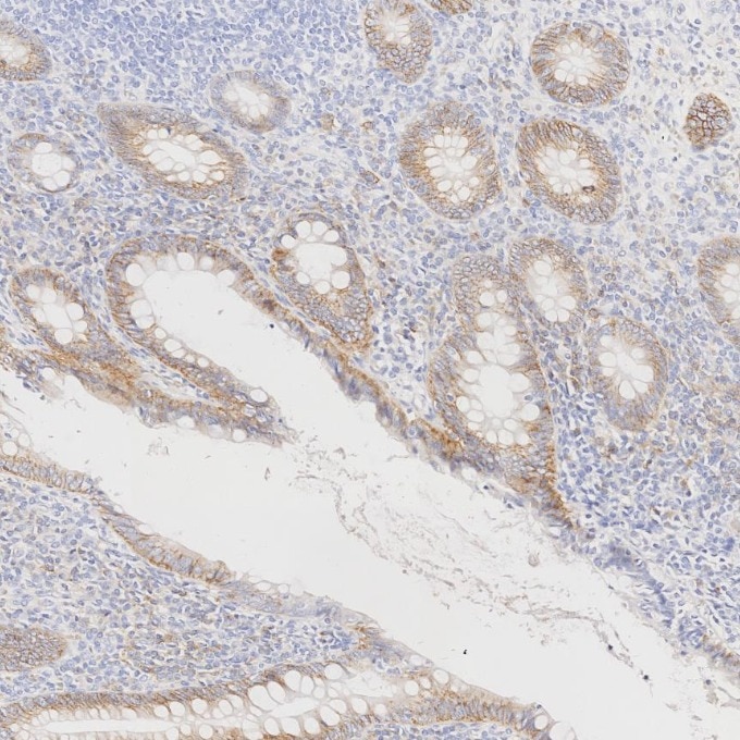 IHC staining of human appendicitis using 67155-1-Ig Immunohistochemistry (IHC) staining of human appendicitis tissue using CD138/Syndecan-1 Monoclonal antibody (67155-1-Ig)