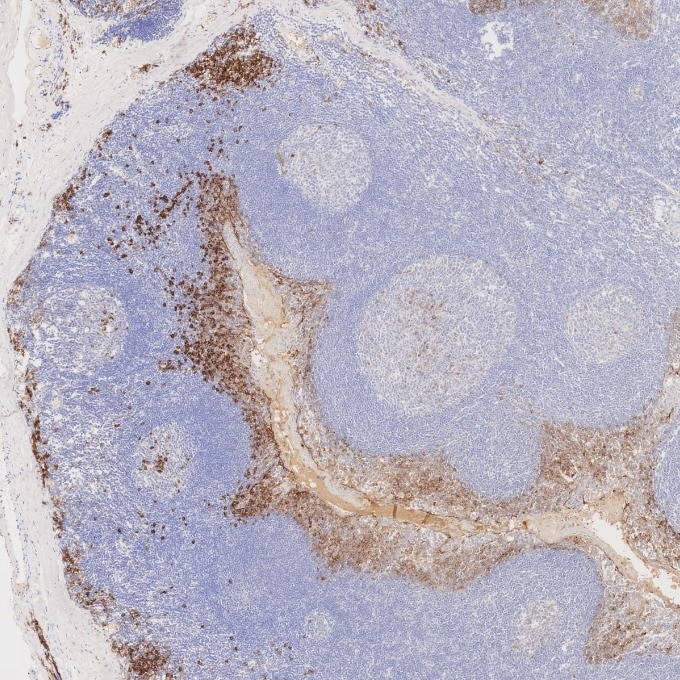 IHC staining of human tonsillitis using 67155-1-Ig Immunohistochemistry (IHC) staining of human tonsillitis tissue using CD138/Syndecan-1 Monoclonal antibody (67155-1-Ig)