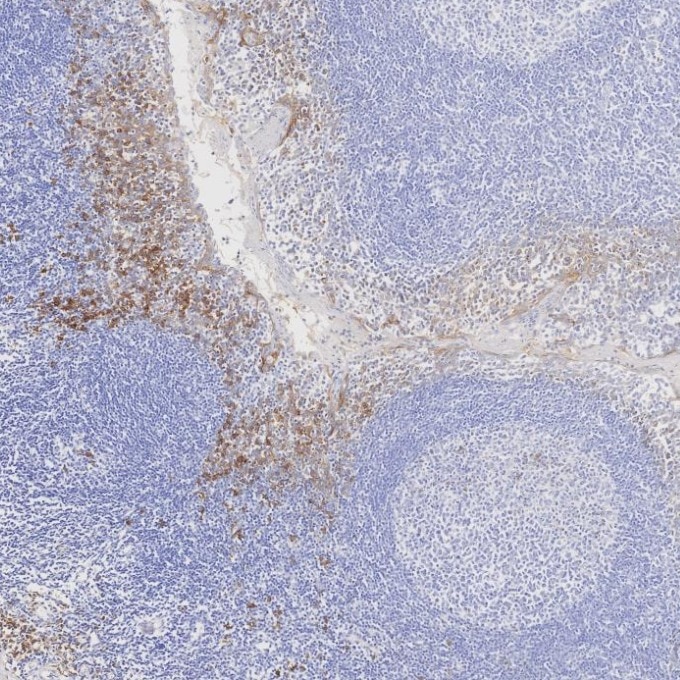 IHC staining of human tonsillitis using 67155-1-Ig Immunohistochemistry (IHC) staining of human tonsillitis tissue using CD138/Syndecan-1 Monoclonal antibody (67155-1-Ig)