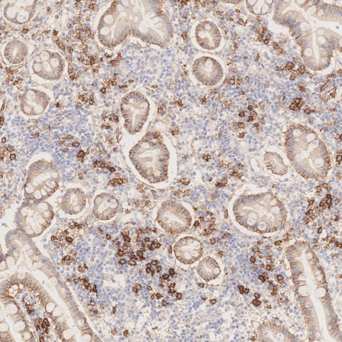 IHC staining of human lymphoma using 67155-1-Ig Immunohistochemistry (IHC) staining of human lymphoma tissue using CD138/Syndecan-1 Monoclonal antibody (67155-1-Ig)