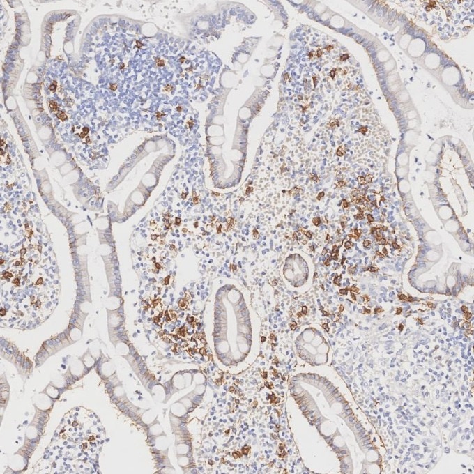 IHC staining of human lymphoma using 67155-1-Ig Immunohistochemistry (IHC) staining of human lymphoma tissue using CD138/Syndecan-1 Monoclonal antibody (67155-1-Ig)