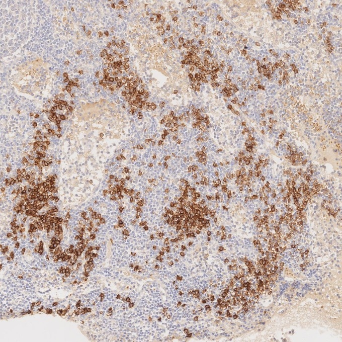 IHC staining of human lymphoma using 67155-1-Ig Immunohistochemistry (IHC) staining of human lymphoma tissue using CD138/Syndecan-1 Monoclonal antibody (67155-1-Ig)