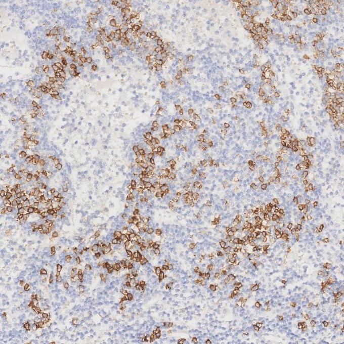 IHC staining of human lymphoma using 67155-1-Ig Immunohistochemistry (IHC) staining of human lymphoma tissue using CD138/Syndecan-1 Monoclonal antibody (67155-1-Ig)