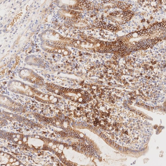 IHC staining of human lymphoma using 67155-1-Ig Immunohistochemistry (IHC) staining of human lymphoma tissue using CD138/Syndecan-1 Monoclonal antibody (67155-1-Ig)