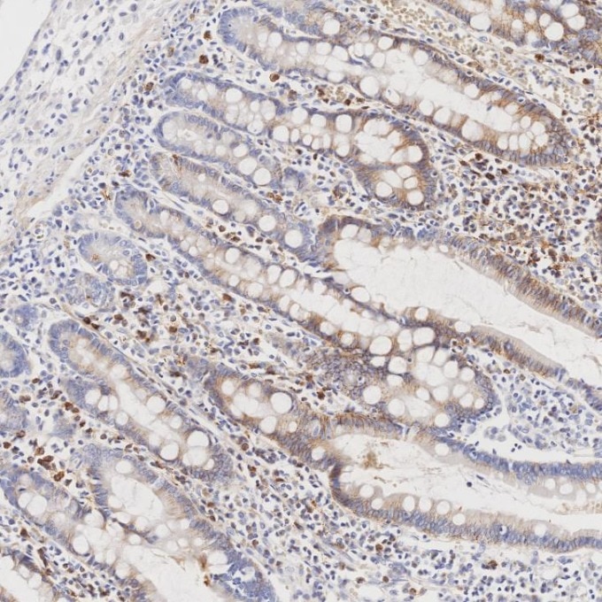 IHC staining of human lymphoma using 67155-1-Ig Immunohistochemistry (IHC) staining of human lymphoma tissue using CD138/Syndecan-1 Monoclonal antibody (67155-1-Ig)