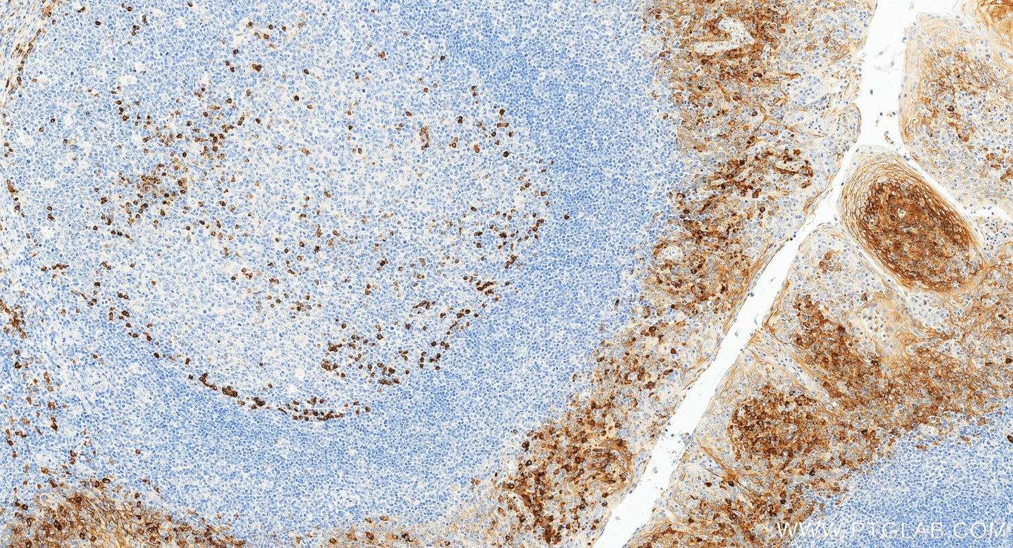 Immunohistochemistry (IHC) staining of human tonsillitis tissue using CD138/Syndecan-1 Monoclonal antibody (67155-1-Ig)