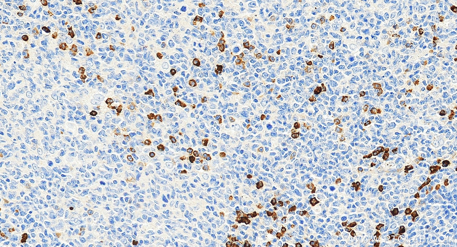Immunohistochemistry (IHC) staining of human tonsillitis tissue using CD138/Syndecan-1 Monoclonal antibody (67155-1-Ig)