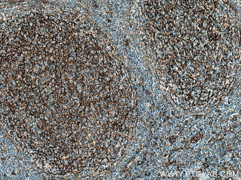 IHC staining of human tonsillitis using 17000-1-AP