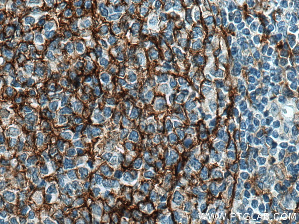 Immunohistochemistry (IHC) staining of human tonsillitis tissue using CD14 Polyclonal antibody (17000-1-AP)
