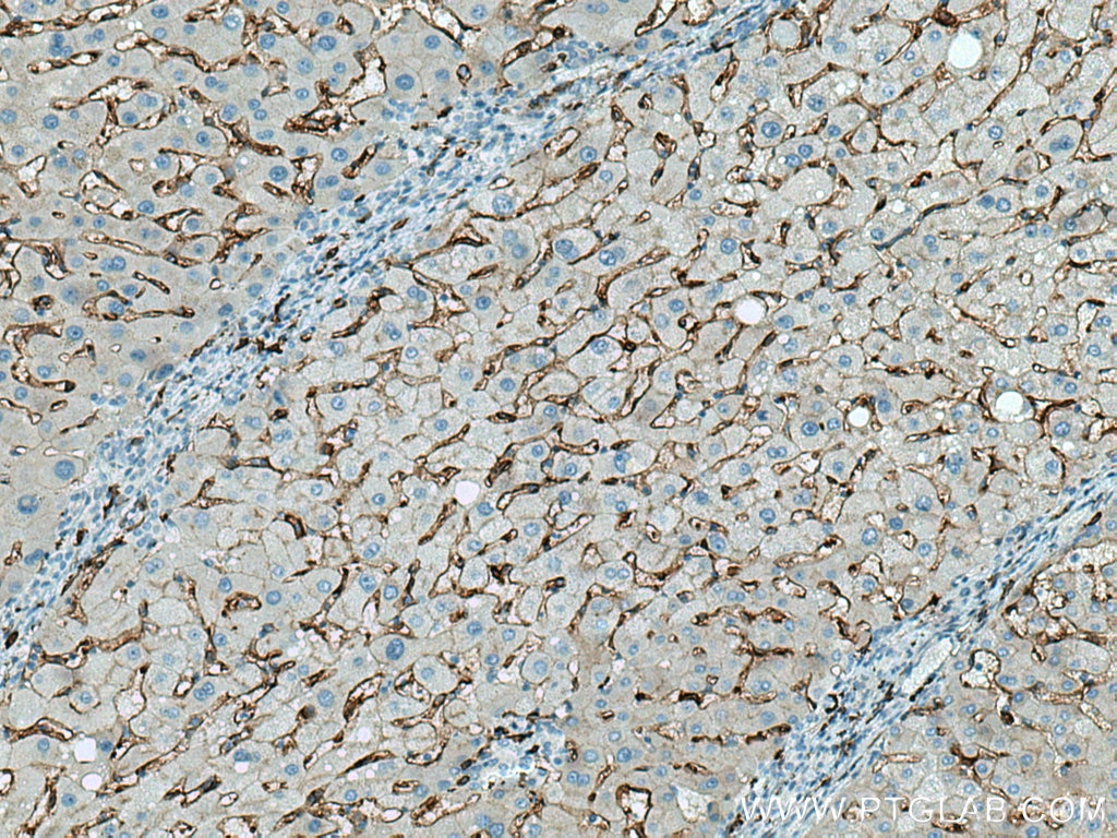 Immunohistochemistry (IHC) staining of human hepatocirrhosis tissue using CD14 Polyclonal antibody (17000-1-AP)