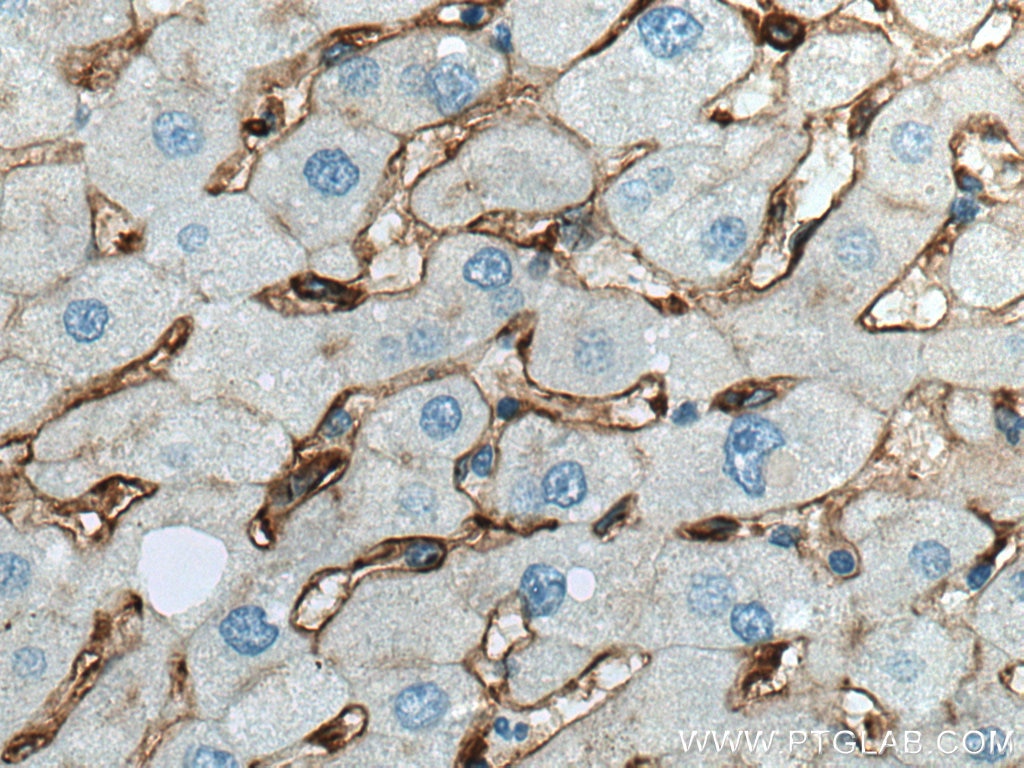 Immunohistochemistry (IHC) staining of human hepatocirrhosis tissue using CD14 Polyclonal antibody (17000-1-AP)