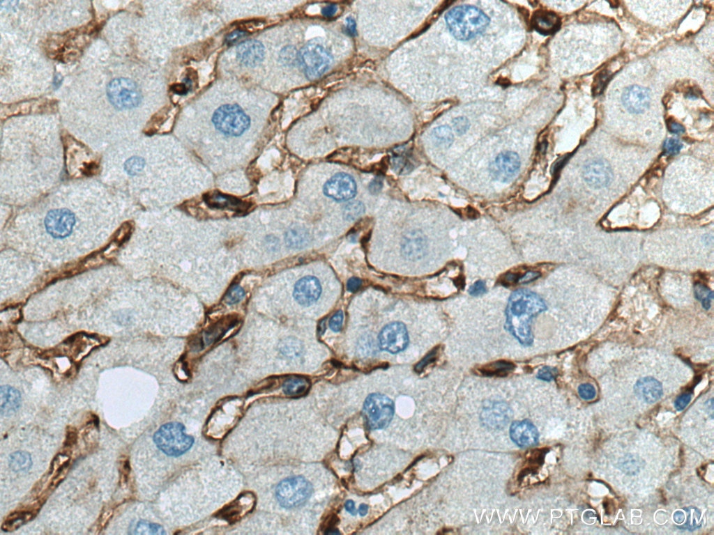 IHC staining of human hepatocirrhosis using 17000-1-AP