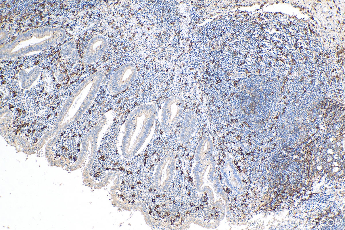 Immunohistochemistry (IHC) staining of human appendicitis tissue using CD14 Polyclonal antibody (17000-1-AP)