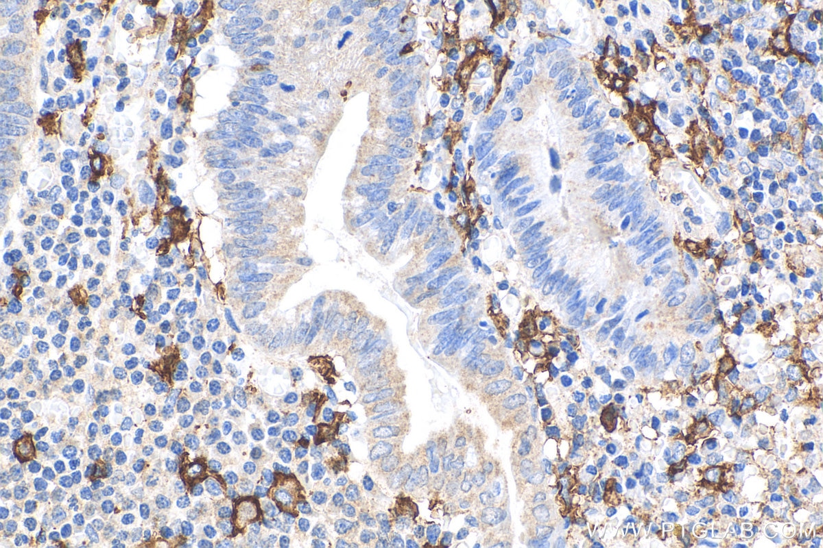 Immunohistochemistry (IHC) staining of human appendicitis tissue using CD14 Polyclonal antibody (17000-1-AP)