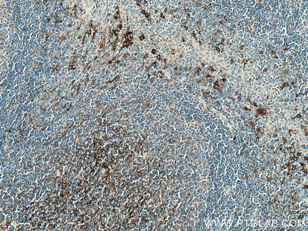 Immunohistochemistry (IHC) staining of human tonsillitis tissue using CD14 Monoclonal antibody (60253-1-Ig)