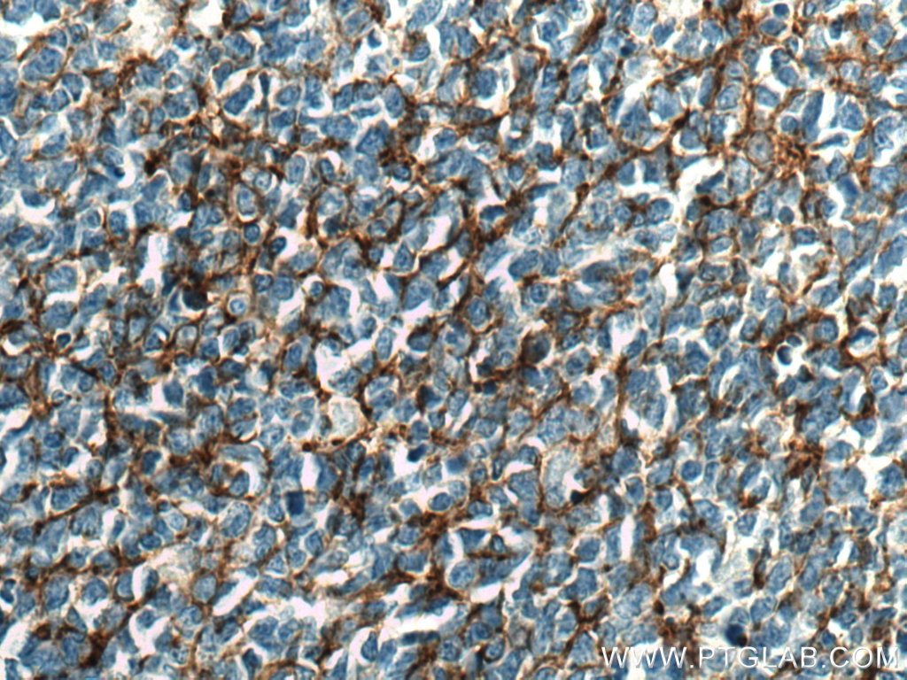 Immunohistochemistry (IHC) staining of human tonsillitis tissue using CD14 Monoclonal antibody (60253-1-Ig)