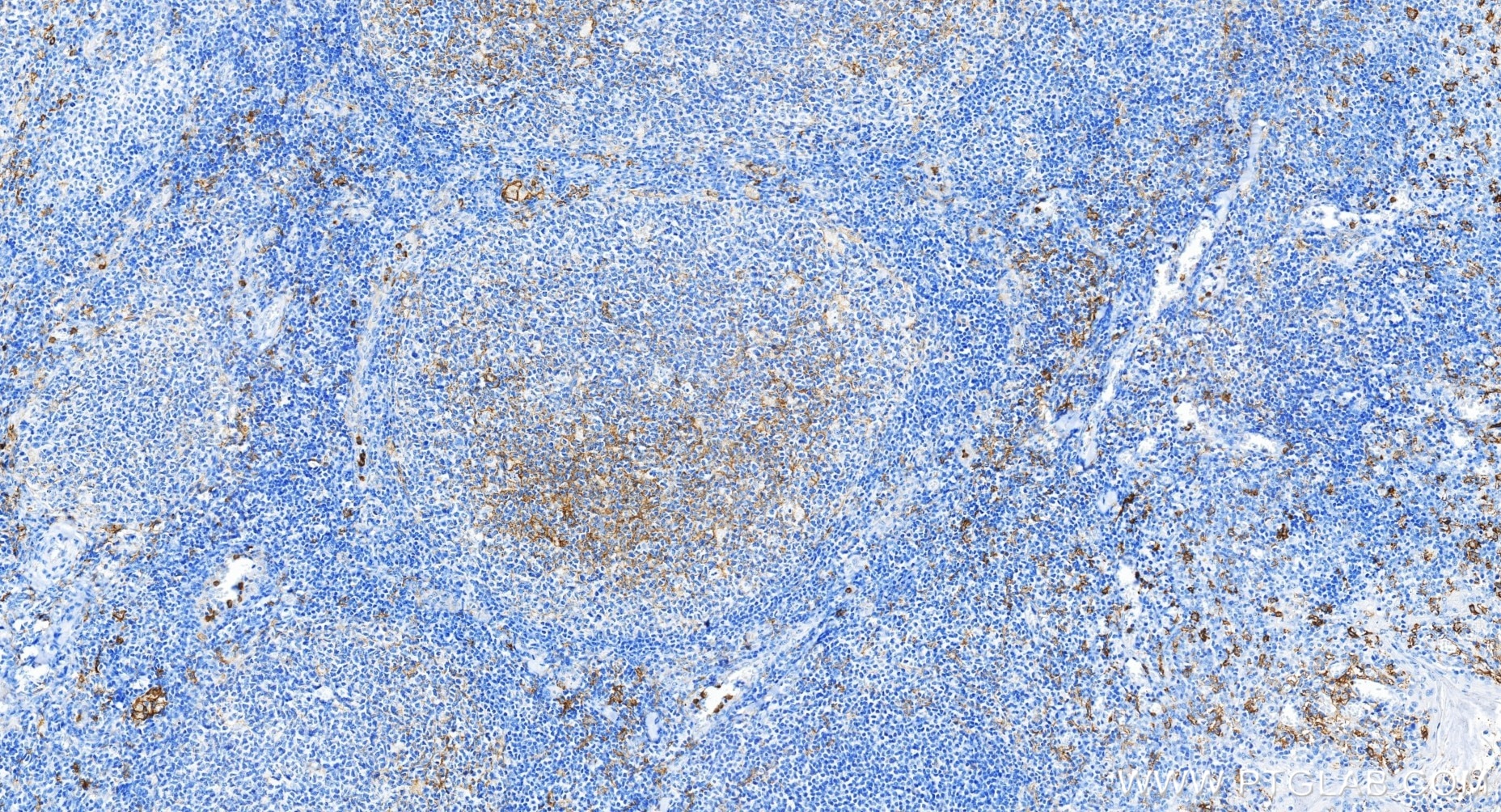 Immunohistochemical analysis of paraffin-embedded human tonsillitis tissue slide using 83055-4-RR (CD14 antibody) at dilution of 1:20000 (under 20x lens). Heat mediated antigen retrieval with Tris-EDTA buffer (pH 9.0). This data was developed using the same antibody clone with 83055-4-PBS in a different storage buffer formulation. Immunohistochemistry (IHC) staining of human tonsillitis tissue using CD14 Recombinant monoclonal antibody (83055-4-RR)