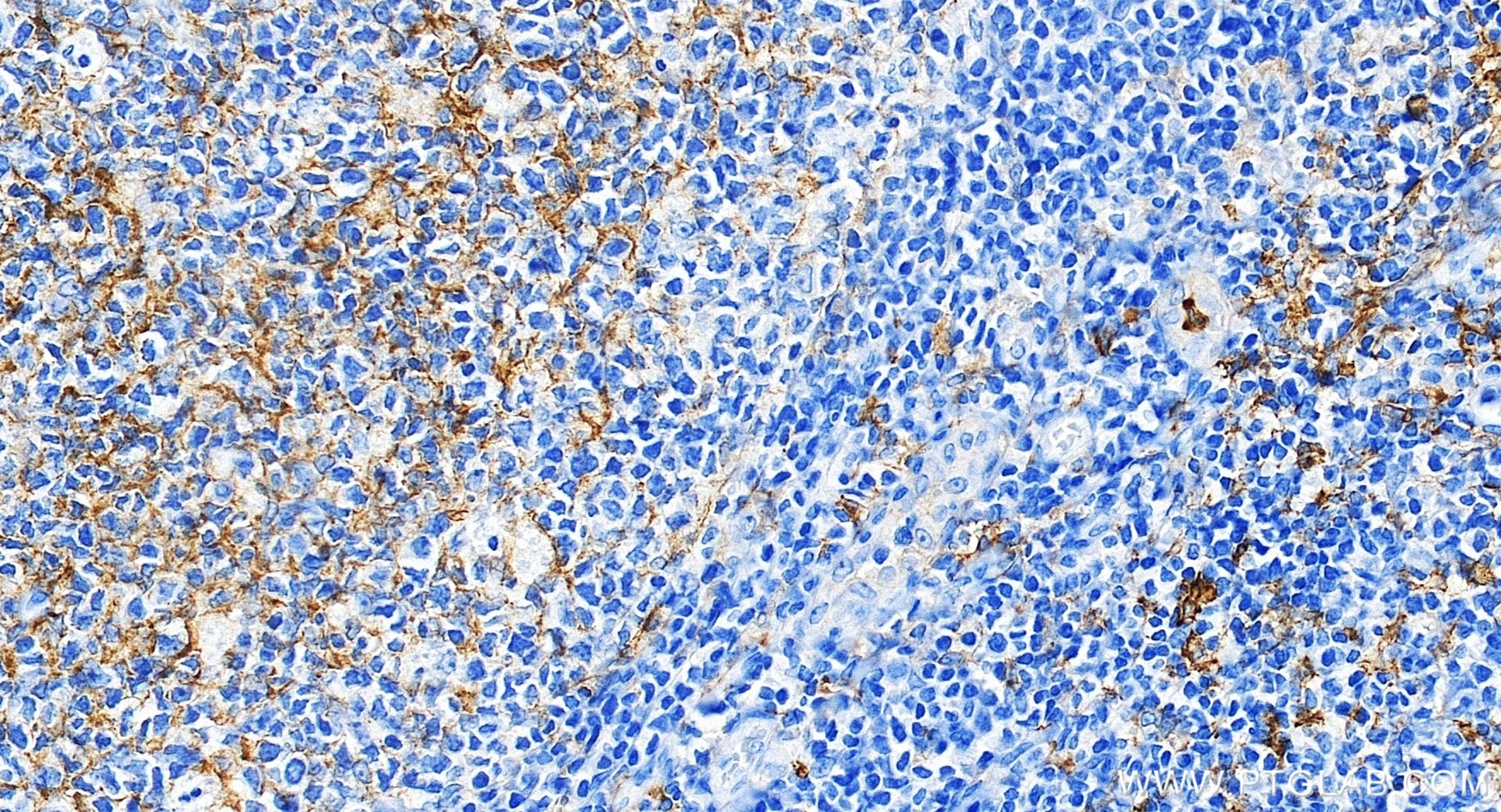 Immunohistochemical analysis of paraffin-embedded human tonsillitis tissue slide using 83055-4-RR (CD14 antibody) at dilution of 1:20000 (under 20x lens). Heat mediated antigen retrieval with Tris-EDTA buffer (pH 9.0). This data was developed using the same antibody clone with 83055-4-PBS in a different storage buffer formulation. Immunohistochemistry (IHC) staining of human tonsillitis tissue using CD14 Recombinant monoclonal antibody (83055-4-RR)