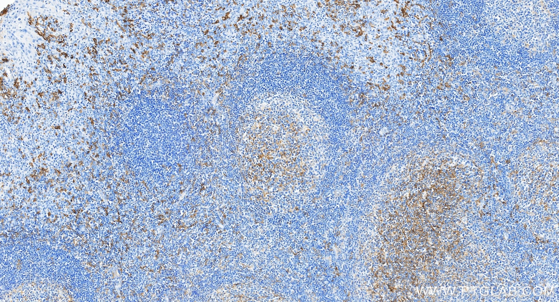 Immunohistochemistry (IHC) staining of human tonsillitis tissue using CD14 Recombinant monoclonal antibody (83055-8-RR)
