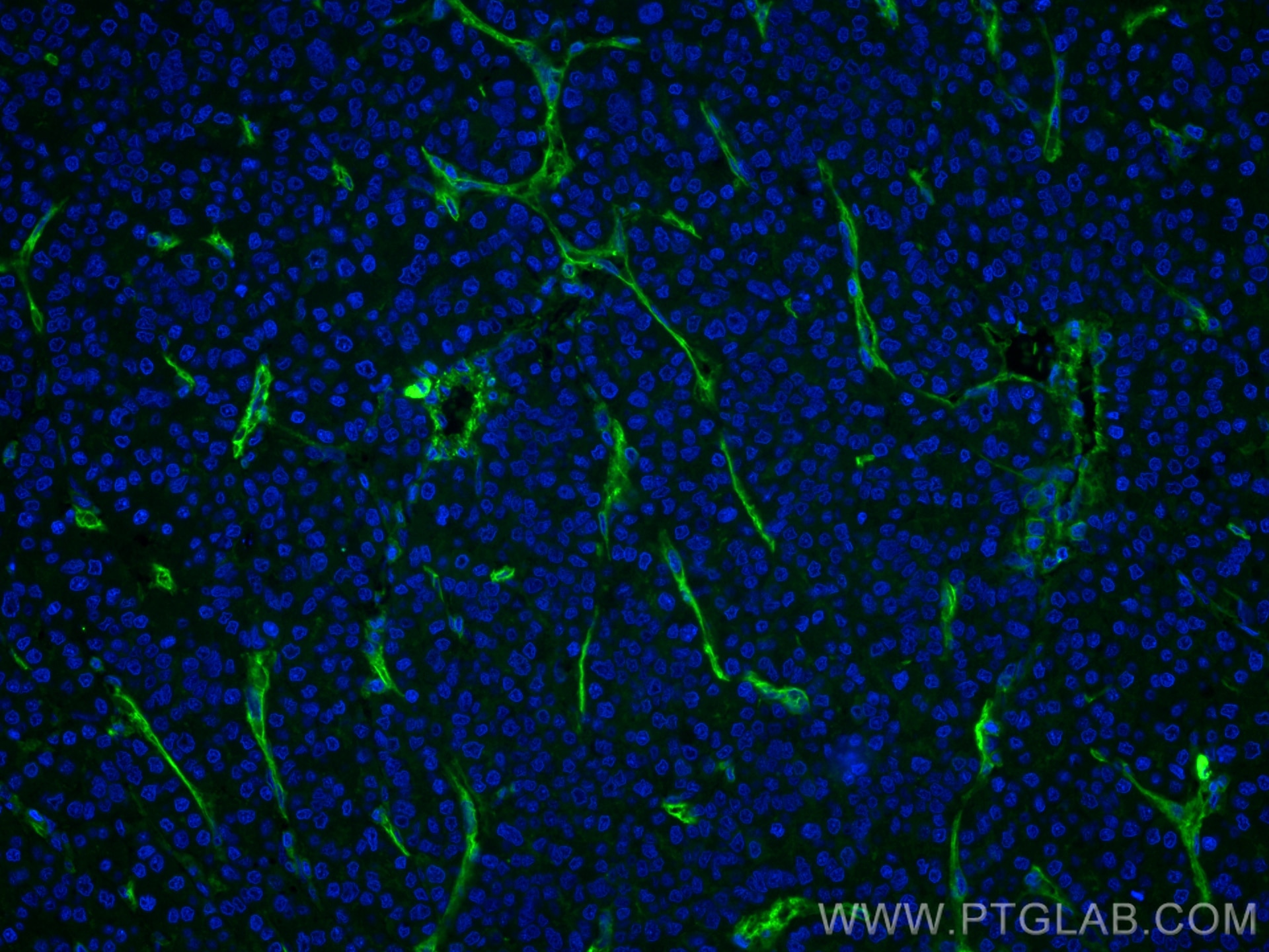 Immunofluorescence (IF) / fluorescent staining of human liver cancer tissue using CD146/MCAM Monoclonal antibody (66153-1-Ig)