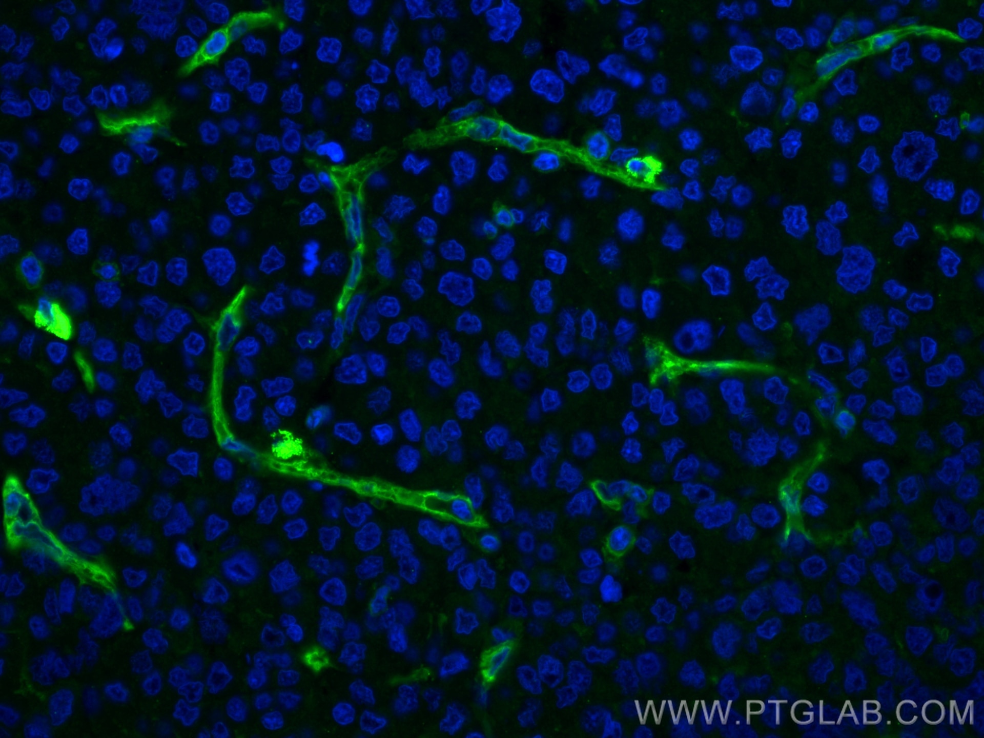 Immunofluorescence (IF) / fluorescent staining of human liver cancer tissue using CD146/MCAM Monoclonal antibody (66153-1-Ig)