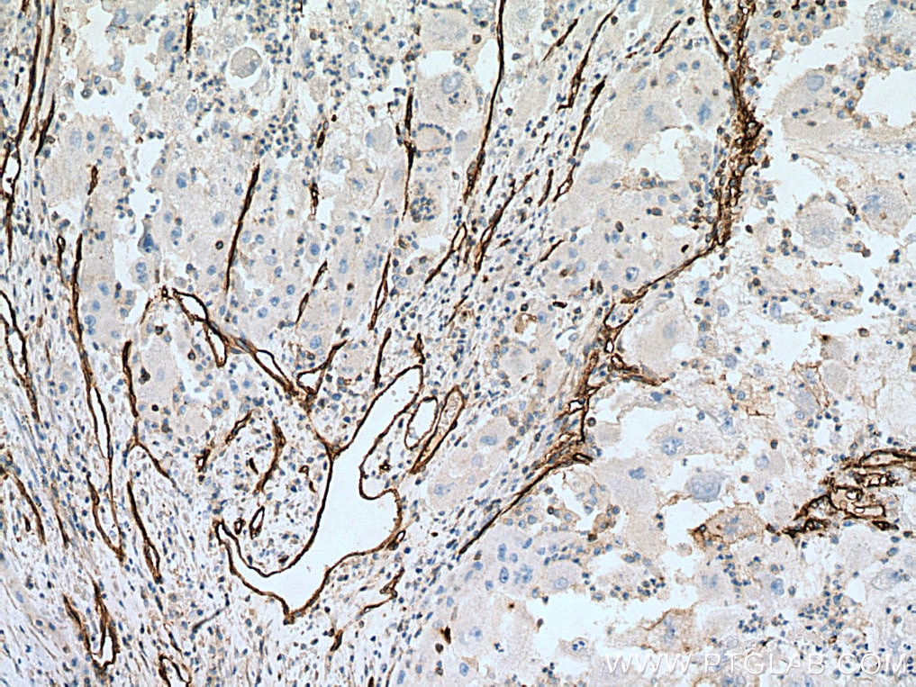 Immunohistochemistry (IHC) staining of human liver cancer tissue using CD146/MCAM Monoclonal antibody (66153-1-Ig)