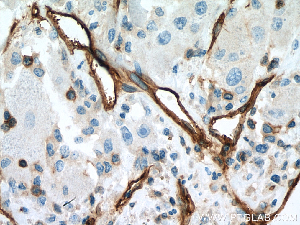 Immunohistochemistry (IHC) staining of human liver cancer tissue using CD146/MCAM Monoclonal antibody (66153-1-Ig)