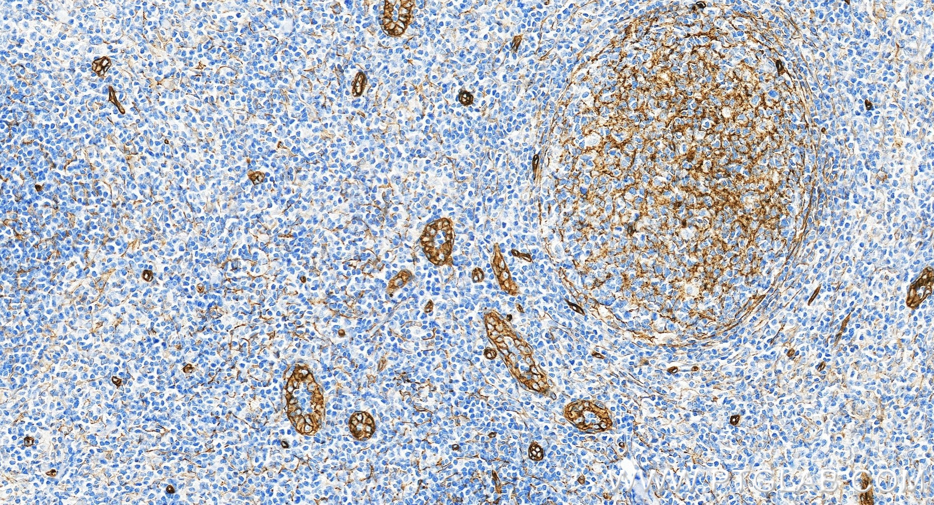 IHC staining of human tonsillitis using 98561-2-RR Immunohistochemistry (IHC) staining of human tonsillitis tissue using Anti-Human CD146/MCAM Rabbit Recombinant Antibody (98561-2-RR)