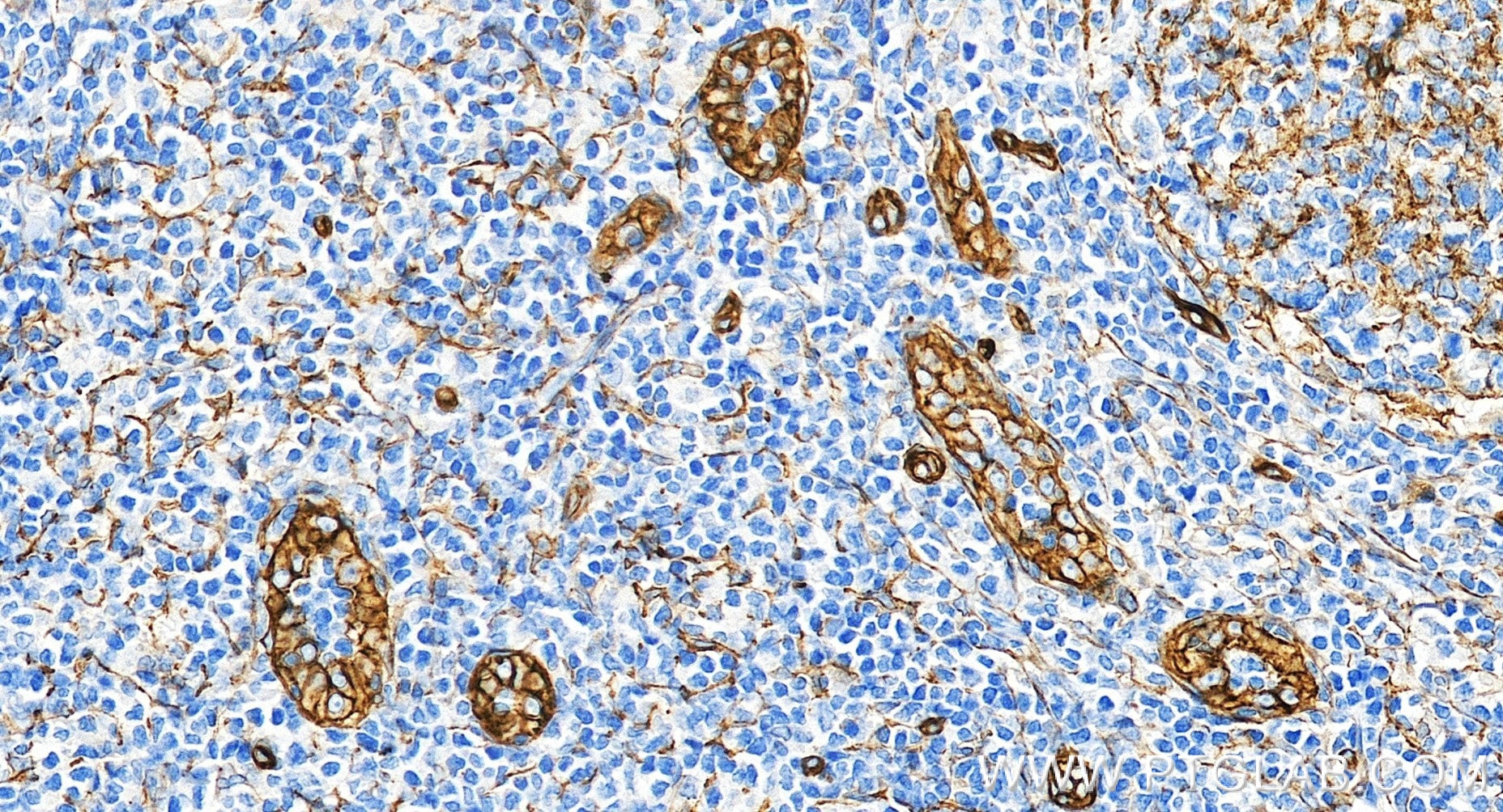 IHC staining of human tonsillitis using 98561-2-RR Immunohistochemistry (IHC) staining of human tonsillitis tissue using Anti-Human CD146/MCAM Rabbit Recombinant Antibody (98561-2-RR)
