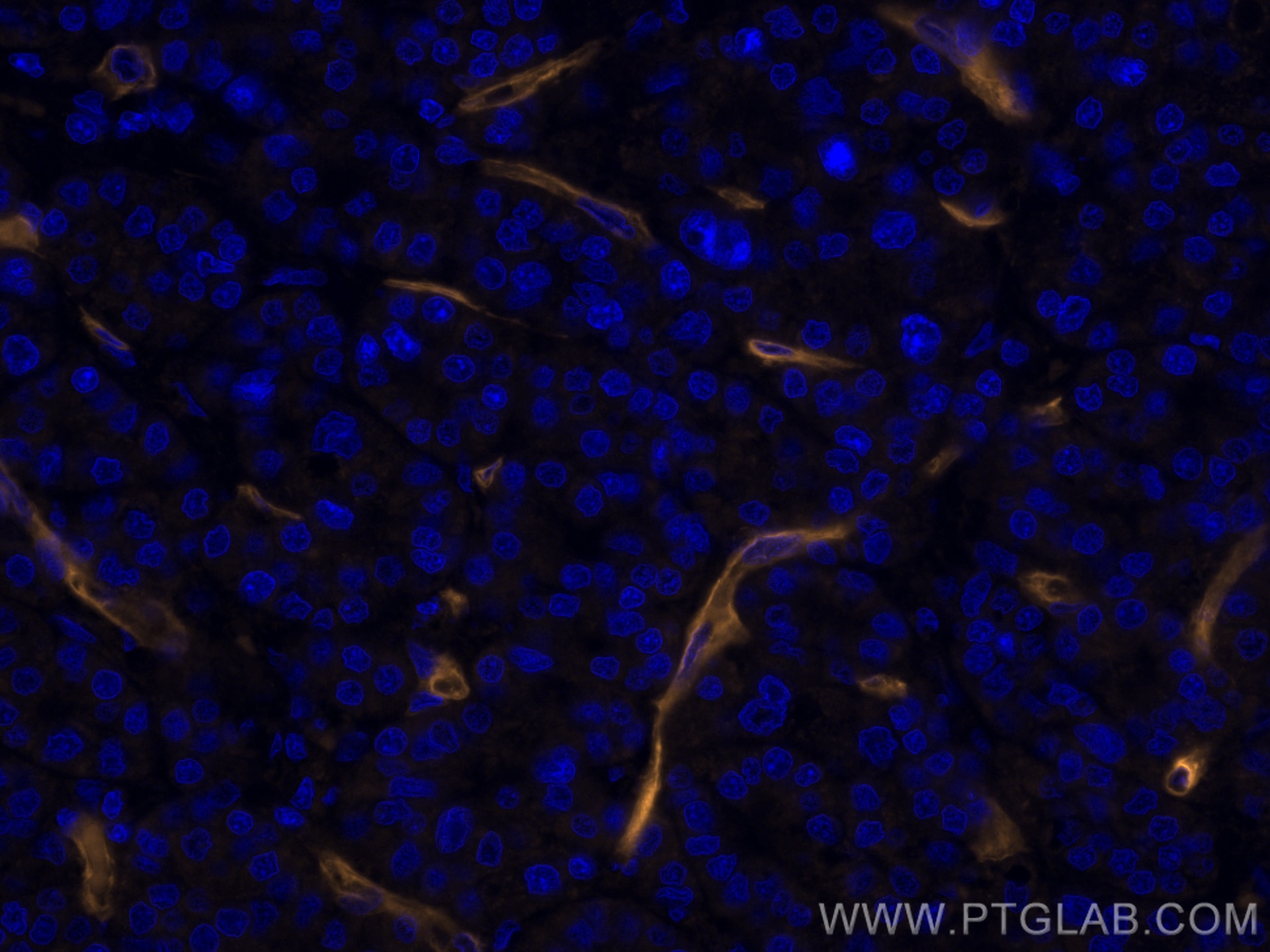 Immunofluorescence (IF) / fluorescent staining of human liver cancer tissue using CoraLite®555-conjugated CD146/MCAM Monoclonal anti (CL555-66153)