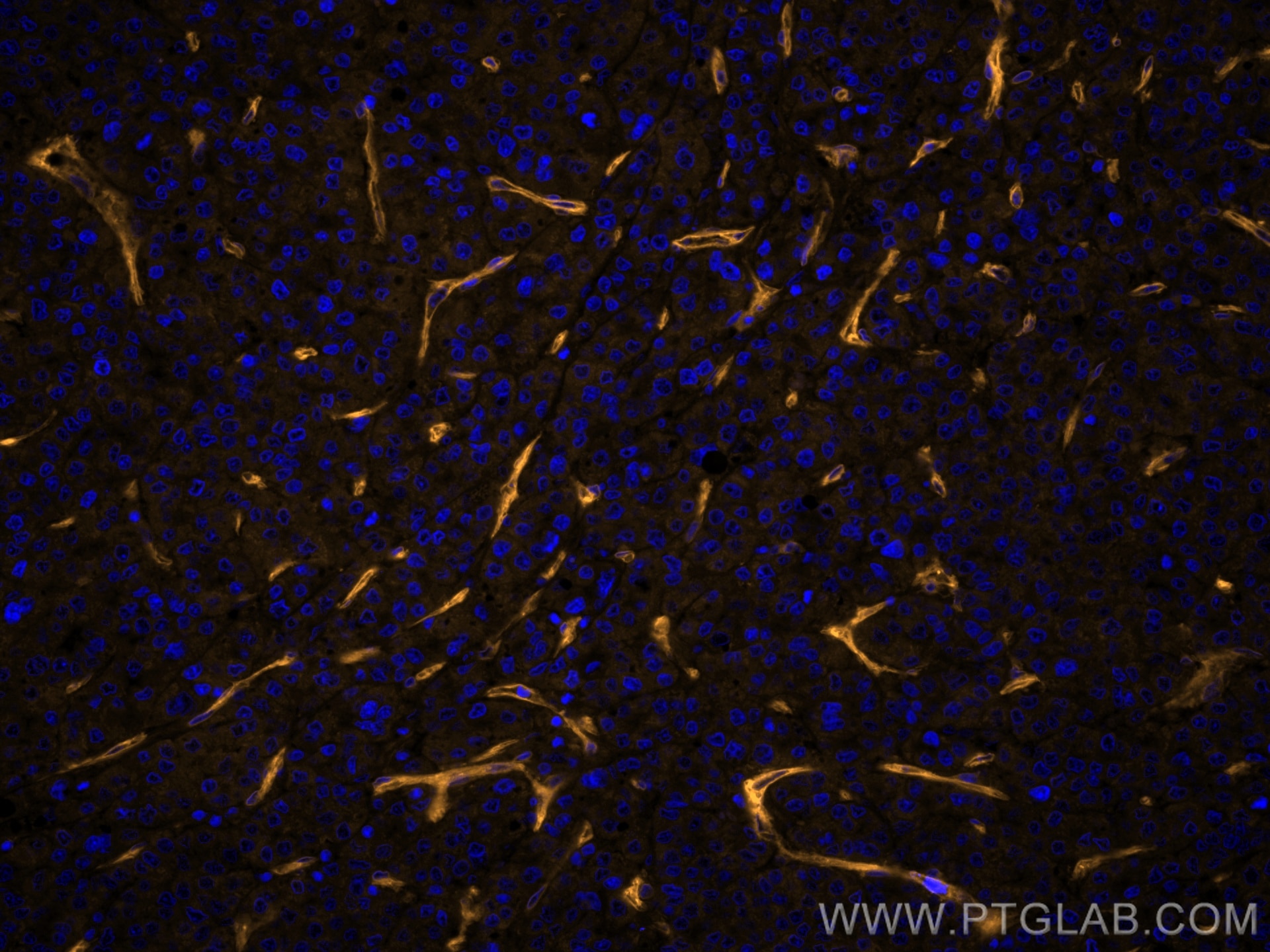 Immunofluorescence (IF) / fluorescent staining of human liver cancer tissue using CoraLite®555-conjugated CD146/MCAM Monoclonal anti (CL555-66153)