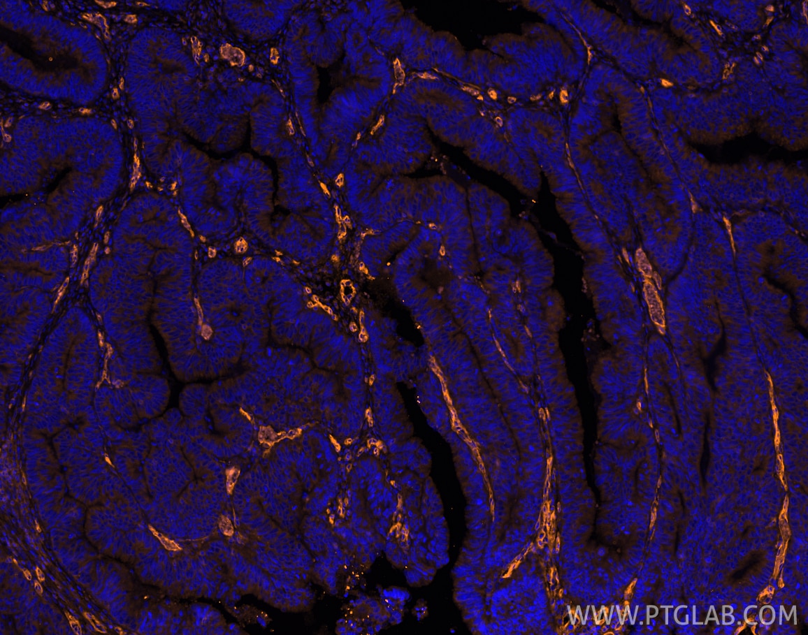 Immunofluorescence (IF) / fluorescent staining of human colon cancer tissue using PE-conjugated CD146/MCAM Monoclonal antibody (PE-66153)