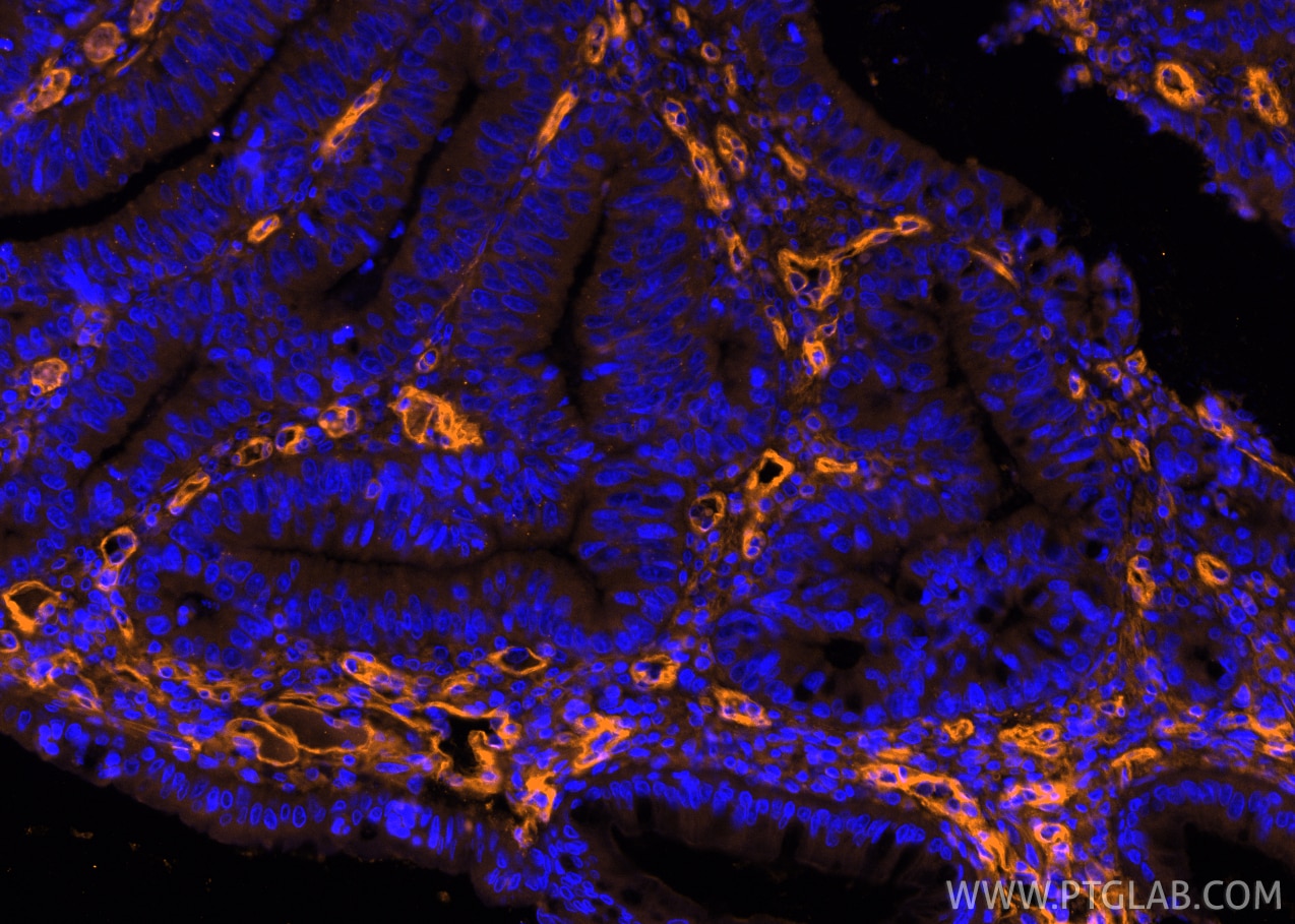 Immunofluorescence (IF) / fluorescent staining of human colon cancer tissue using PE-conjugated CD146/MCAM Monoclonal antibody (PE-66153)