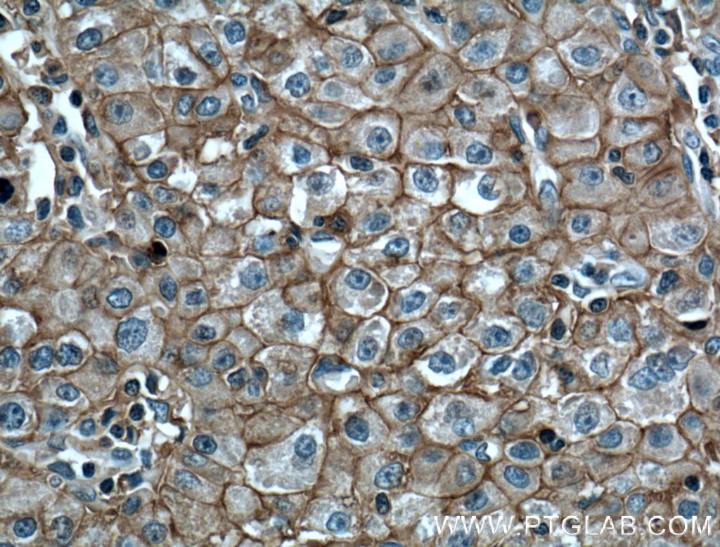 Immunohistochemistry (IHC) staining of human liver cancer tissue using CD147 Monoclonal antibody (66443-1-Ig)