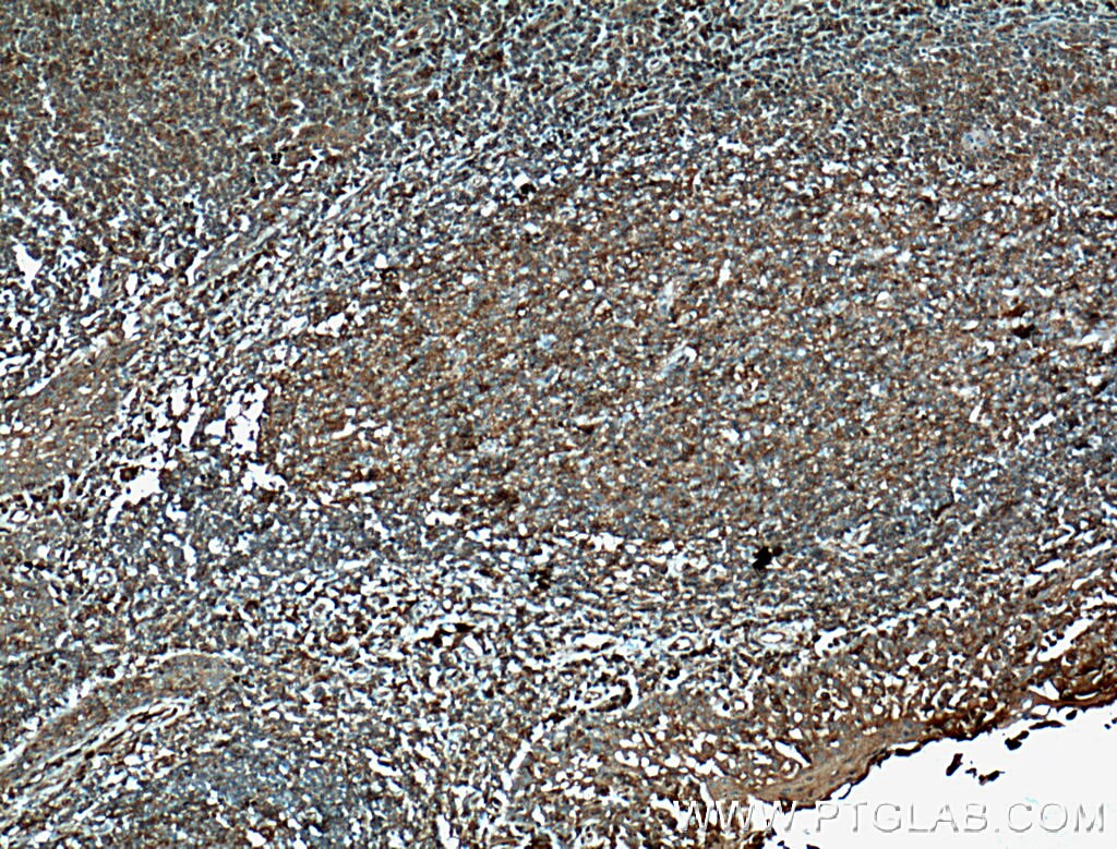 Immunohistochemistry (IHC) staining of human tonsillitis tissue using CD147 Monoclonal antibody (66443-1-Ig)