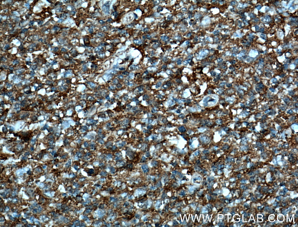 Immunohistochemistry (IHC) staining of human tonsillitis tissue using CD147 Monoclonal antibody (66443-1-Ig)