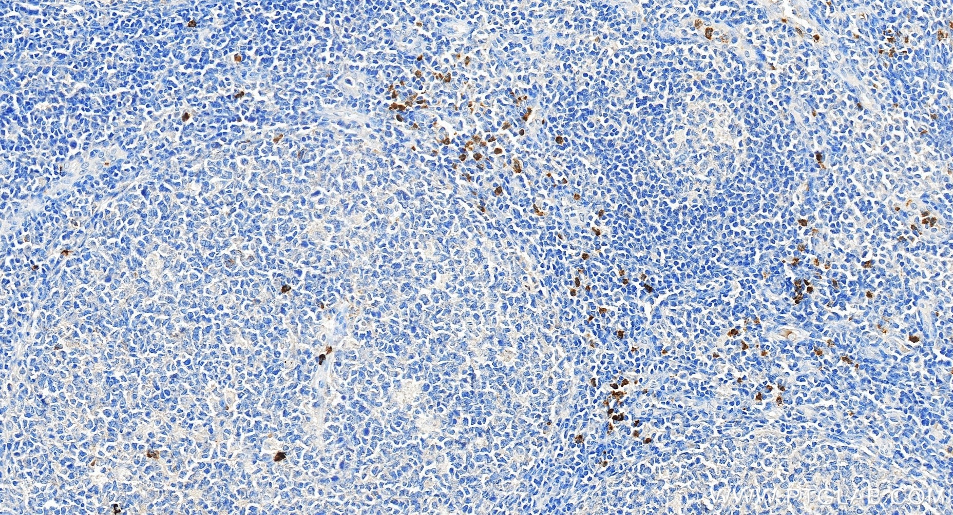 Immunohistochemical analysis of paraffin-embedded human tonsillitis tissue slide using 98616-1-RR (CD15 antibody) at dilution of 1:200 (under 20x lens). Heat mediated antigen retrieval with Tris-EDTA buffer (pH 9.0). This data was developed using the same antibody clone with 98616-1-PBS in a different storage buffer formulation. Immunohistochemistry (IHC) staining of human tonsillitis tissue using Anti-Human CD15 Rabbit Recombinant Antibody (98616-1-RR)