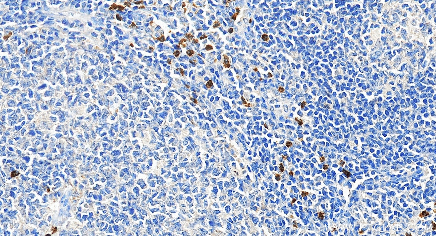 Immunohistochemical analysis of paraffin-embedded human tonsillitis tissue slide using 98616-1-RR (CD15 antibody) at dilution of 1:200 (under 40x lens). Heat mediated antigen retrieval with Tris-EDTA buffer (pH 9.0). This data was developed using the same antibody clone with 98616-1-PBS in a different storage buffer formulation. Immunohistochemistry (IHC) staining of human tonsillitis tissue using Anti-Human CD15 Rabbit Recombinant Antibody (98616-1-RR)