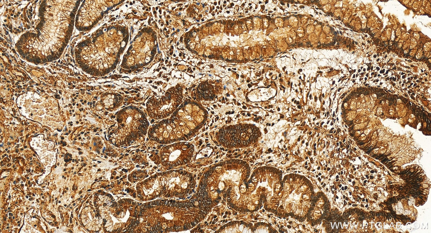 Immunohistochemistry (IHC) staining of human stomach cancer tissue using CD151 Polyclonal antibody (27816-1-AP)