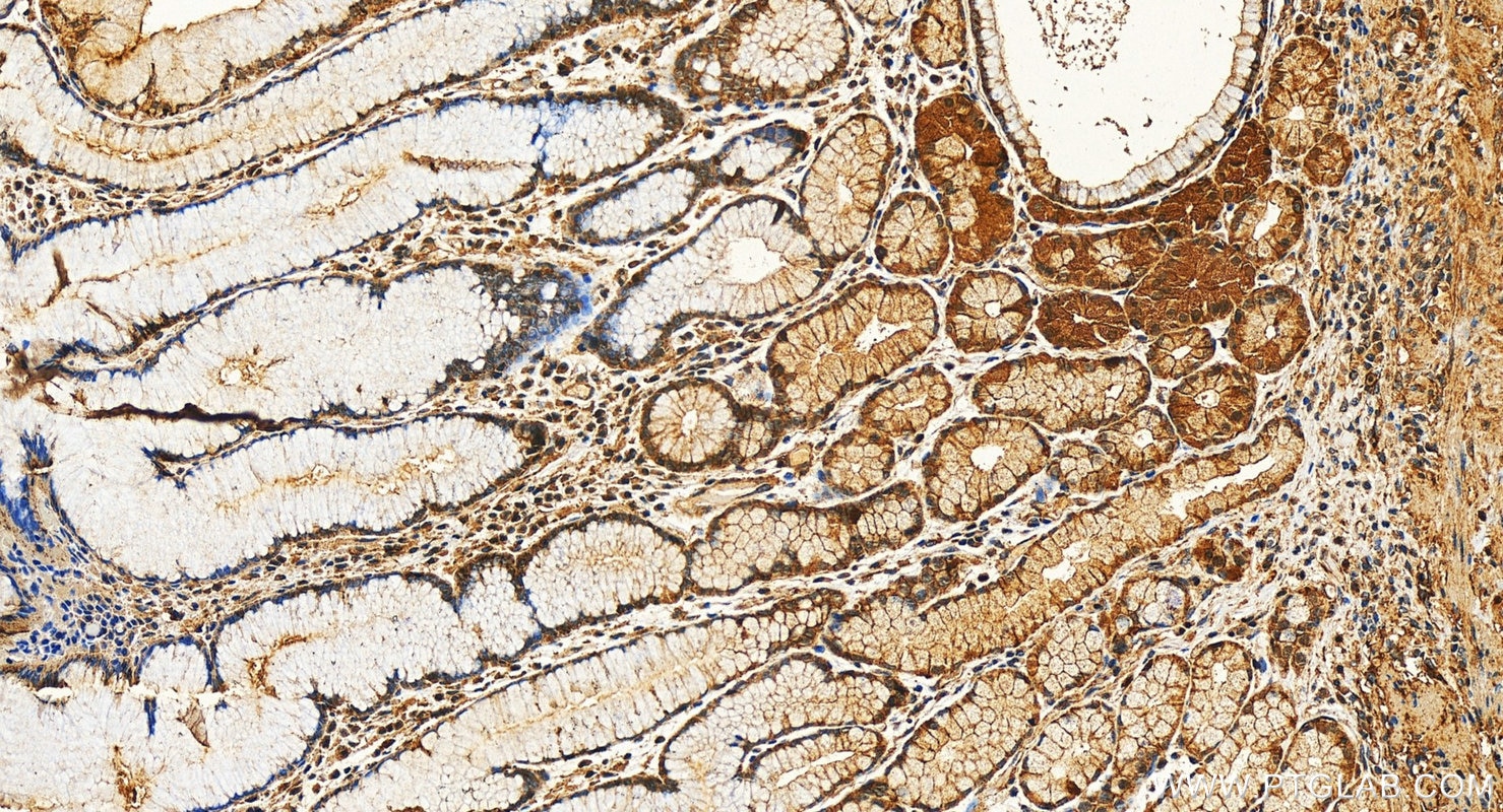 Immunohistochemistry (IHC) staining of human stomach cancer tissue using CD151 Polyclonal antibody (27816-1-AP)