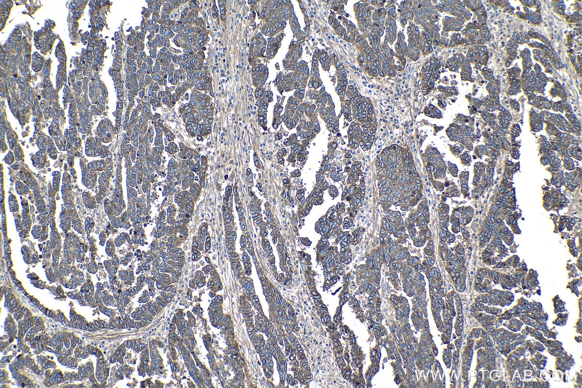 Immunohistochemistry (IHC) staining of human ovary tumor tissue using CD151 Polyclonal antibody (27816-1-AP)