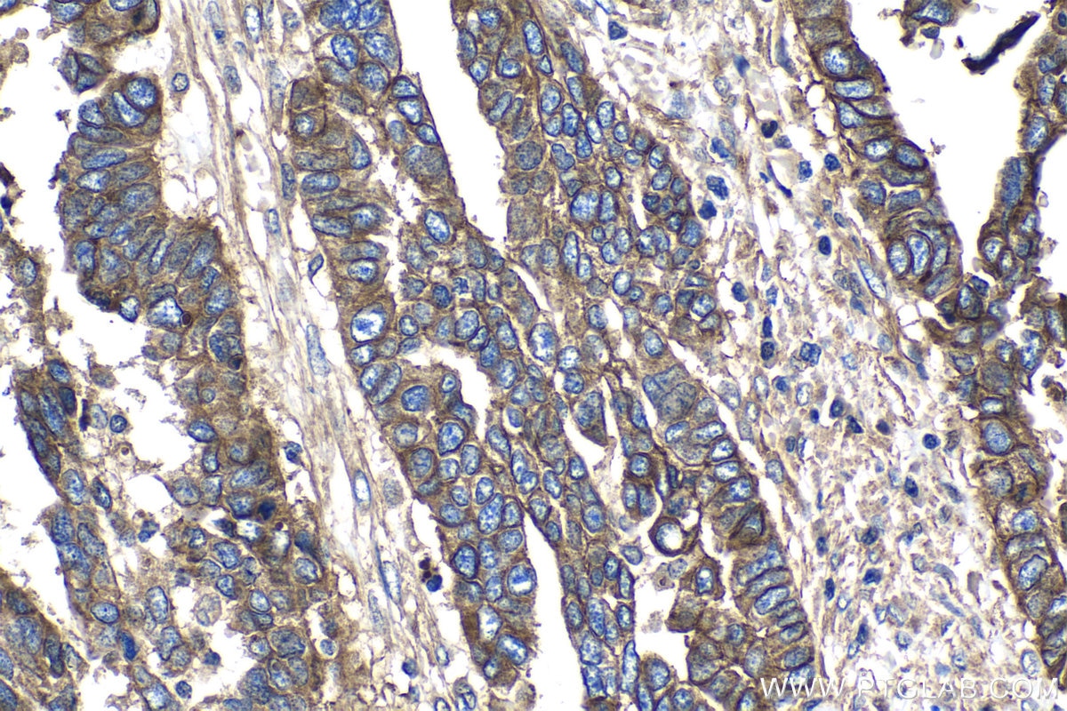 Immunohistochemistry (IHC) staining of human ovary tumor tissue using CD151 Polyclonal antibody (27816-1-AP)