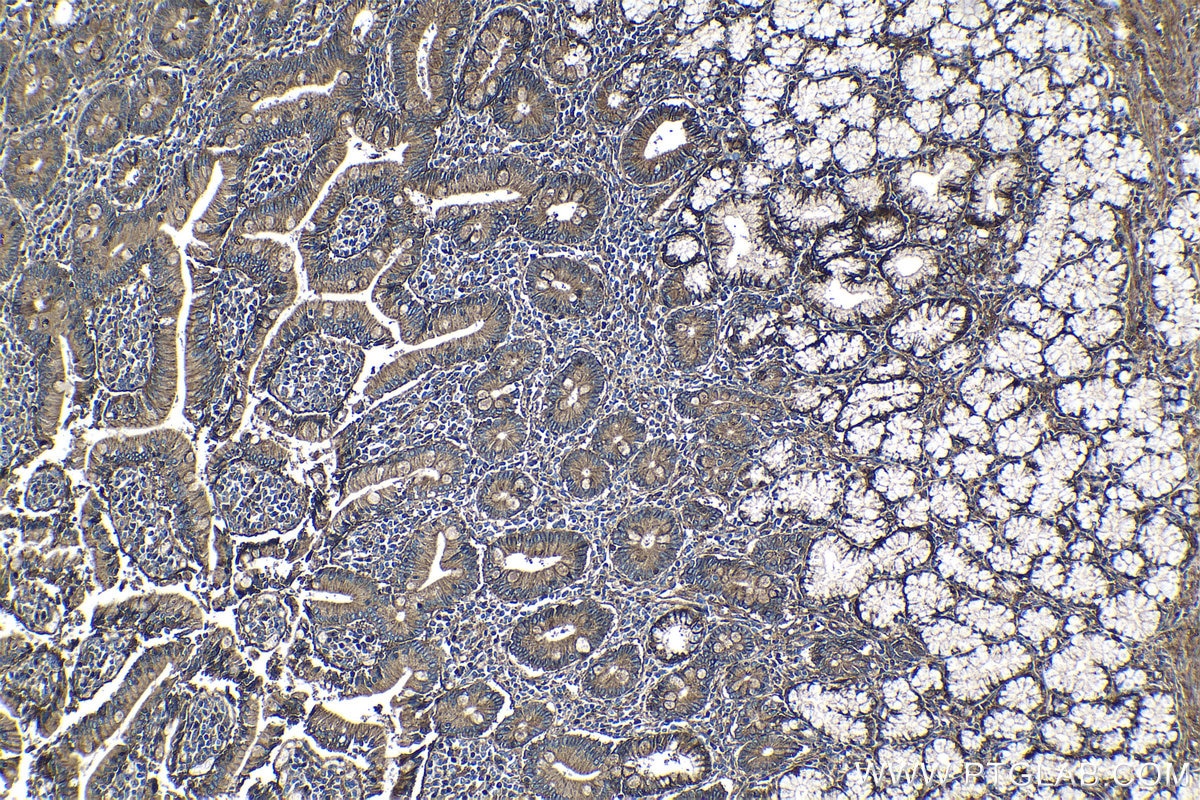 Immunohistochemistry (IHC) staining of human stomach cancer tissue using CD151 Polyclonal antibody (27816-1-AP)