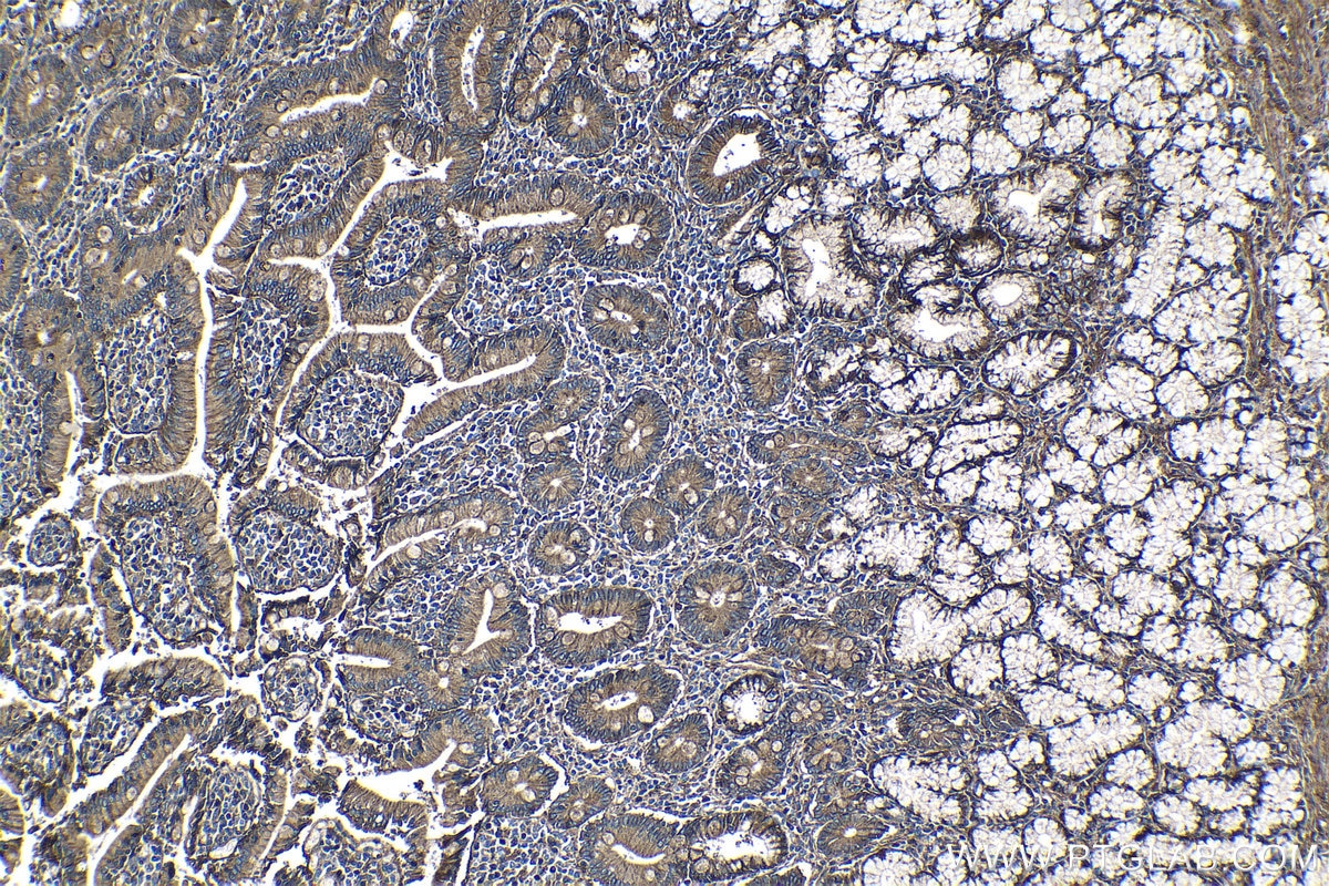 IHC staining of human stomach cancer using 27816-1-AP