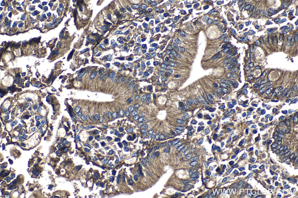 Immunohistochemistry (IHC) staining of human stomach cancer tissue using CD151 Polyclonal antibody (27816-1-AP)