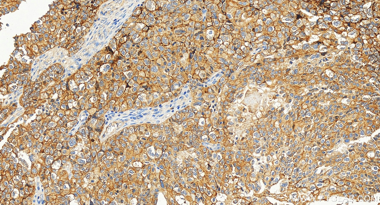 Immunohistochemistry (IHC) staining of human ovary tumor tissue using CD151 Polyclonal antibody (27816-1-AP)
